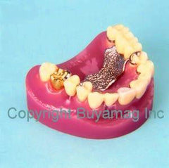 Dental Implants & Crown & Bridge Combination 9 parts Model