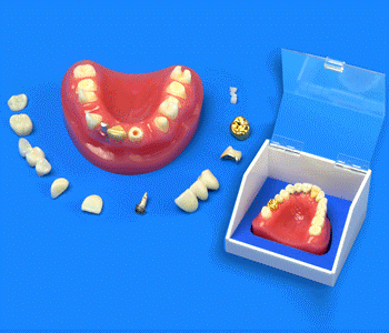 dental onlay inlay model implant crown bridge 