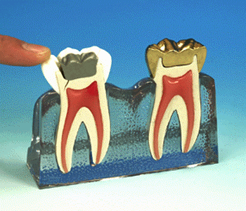 cracked tooth syndrome model