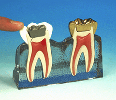 cracked tooth syndrome model