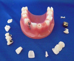 dental restoration Implant bridge model