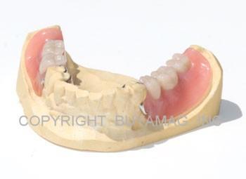 Complete Partial dental model