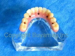 implant Dental Restoration model