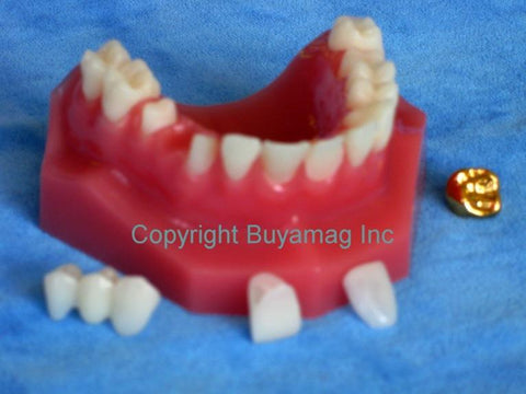 dental bridge veneer gold crown model