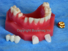 Dental Restoration model