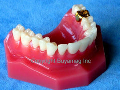 dental inlay crown bridge model