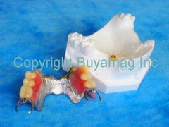 dental implant locator thermoflex parcial model