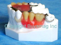 dental implant locator restoration parcial model