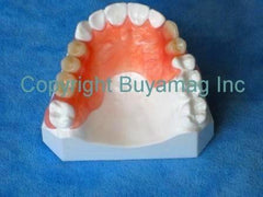partial Dental Restoration model