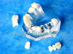 Dental Porcelain Bridge Implant Supported Model Bridge & Single Tooth Implant