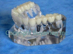 Dental Porcelain Bridge Implant Supported Model Bridge & Single Tooth Implant