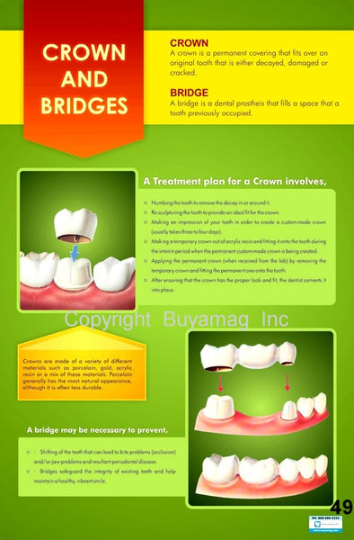 Dental Poster Crowns Bridges Office Patient Education
