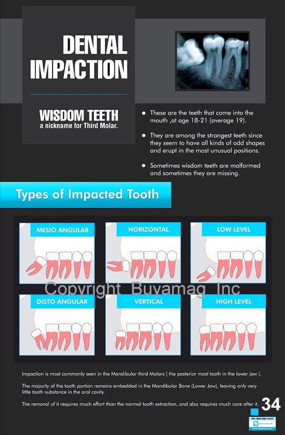 Dental Poster Dental Impaction Office Patient Education – Buyamag INC