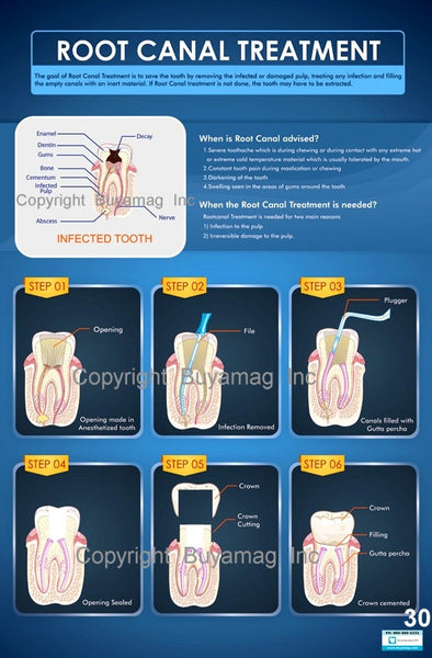 Dental Poster Root Canal Treatment Office Patient Education