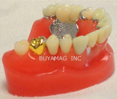 Dental Implants & Crown & Bridge Combination 9 parts Model