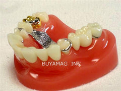 Dental Implants & Crown Bridge Model