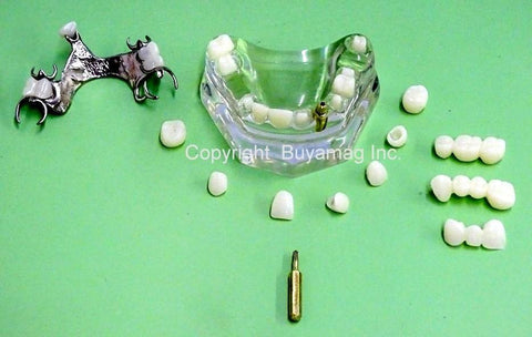 dental implant models veneer bridges inlay restoration