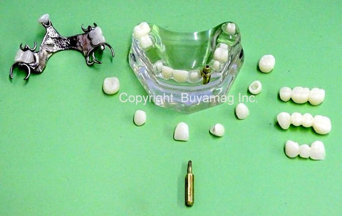 crown restoration bridge dental model