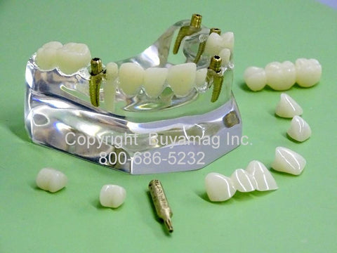 Dental Implant Advanced Combo 5 Implants 2 Bridges 5 Crowns 4 Abutments Kit of 13 pc