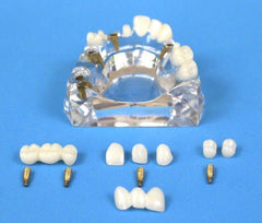 Dental Implant Advanced Combo 5 Implants 2 Bridges 5 Crowns 4 Abutments Kit of 13 pc