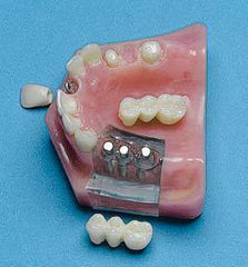 Implants Denture Bridge Combo