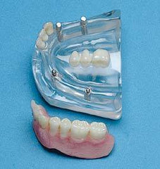 bridge implants dental model