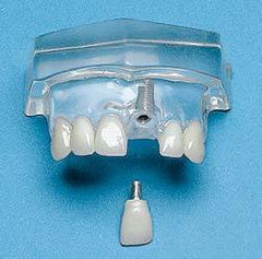 Single Central Tooth Implant 2 Parts