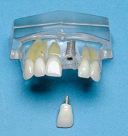 Single 1 Central Tooth Implant 2 Parts