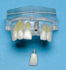 Single 1 Central Tooth Implant 2 Parts