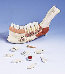 Advanced Half Lower Jaw With 8 Diseased Teeth, 19 Part