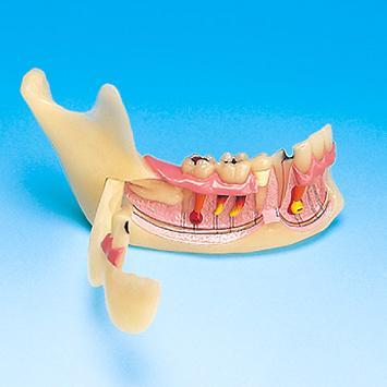 Half Lower Jaw Open Gum Bone Pathological Diseases