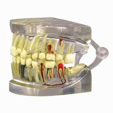 dental model with pathologies disease