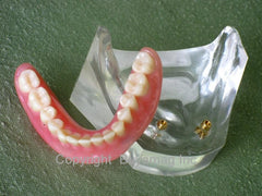 Dental Restoration model