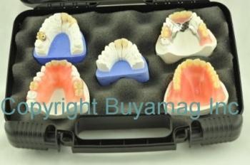 Dental Restoration Kit of 5 - Patients Education Practice Building