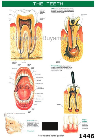 Dental Poster Teeth Structure & Root Canal Therapy Caries Disease