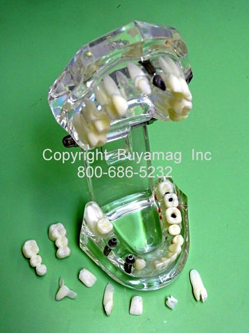 Dental Implant Model Cosmetic Restoration: – Buyamag INC
