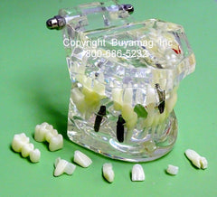 restoration dental model