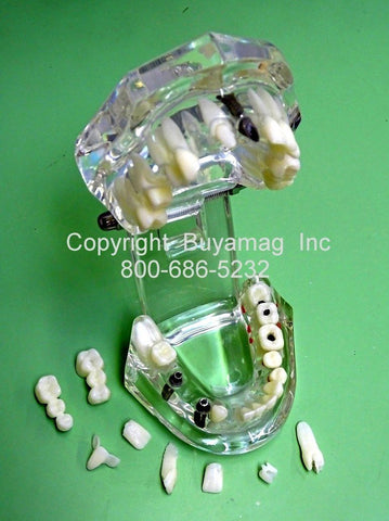Upper & Lower Jaws Advanced Dental Work Restoration Combination 3 Implant 2 Bridges 7 Crowns Veneer In Lay Kit of 9 Parts Dental Implants Restoration Bridges Crowns Combo