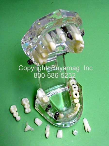 dental implant models bridges inlay