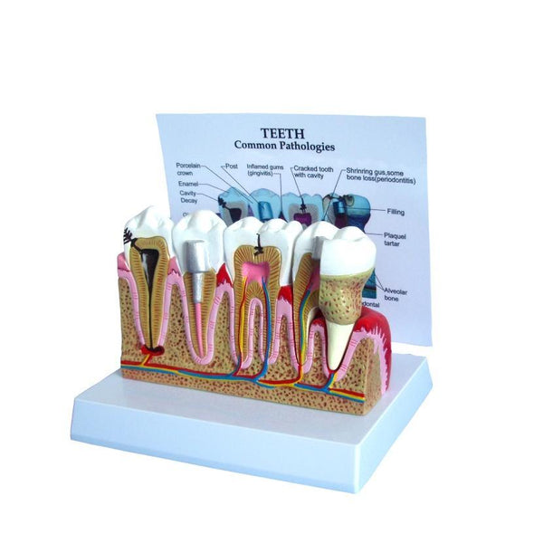 teeth disese pathologies model