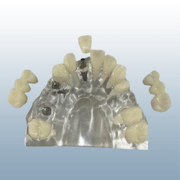 dental implant bridge model