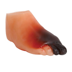 diabetic ulser foot model