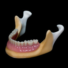 Edentulous Mandible Overdanture Model