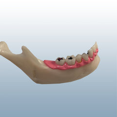 Endodontic pathological caries model