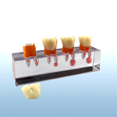 endodontic treatment molar model