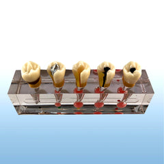 Endodontic Sequence premolar treatment model