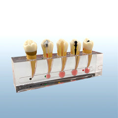 Endodontic treatment premolar sequence bicuspid tooth model