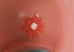 Optional  15 Polyps