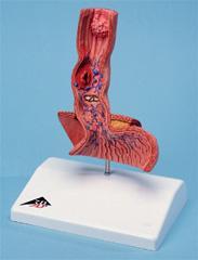 Esophagus Disease Model