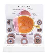 Cataract Eye Model With 6 lenses